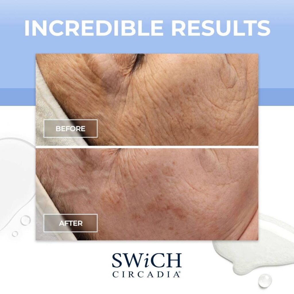 Swich chemical peel before and after