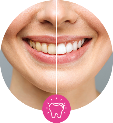 Tooth whitening in Fuquay-Varina